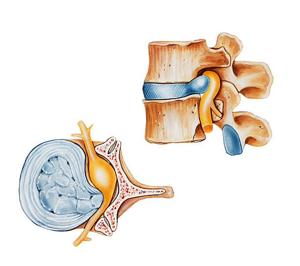 ilustraciones, imágenes clip art, dibujos animados e iconos de stock de spine-herniated (slipped o rotura de disco) - slipped disc