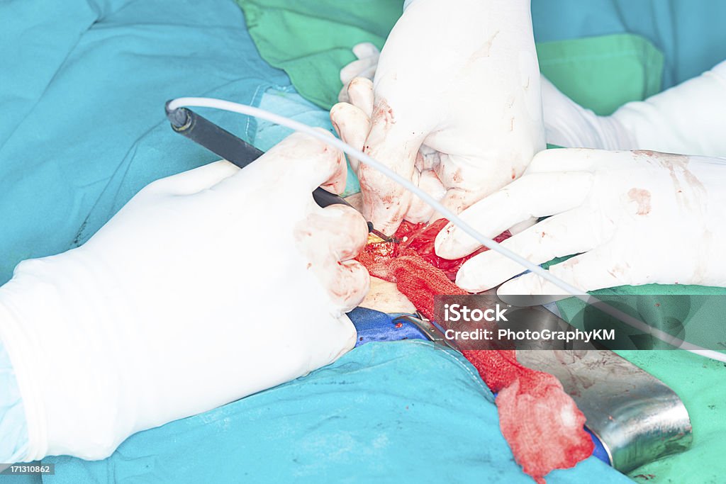 Inguinal Hernia Chirurgie - Lizenzfrei Arzt Stock-Foto