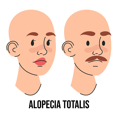 Alopecia totalis vector isolated. Male and female character suffering from hair loss. Completely bald head. Medical condition. Baldness, scalp disease.