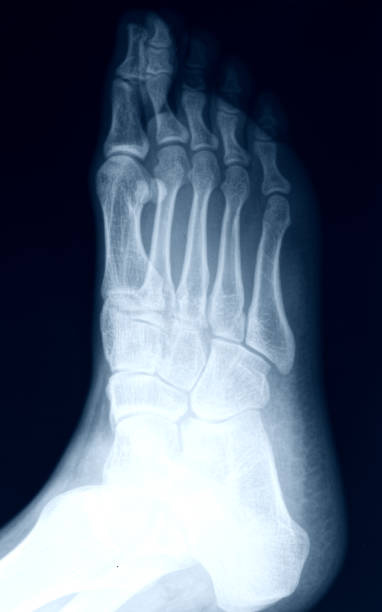 istock X-Ray image of the Foot 171320943