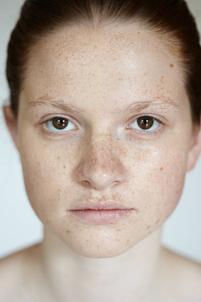 istock Girl With Freckles 171346095