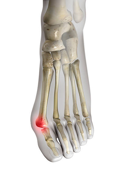 alluce valgo (hallux valgus) - human foot bunion pain human toe foto e immagini stock