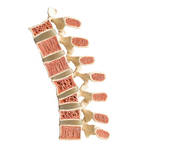 Model of the human spine isolated on a white background showing various defects in the bones and vertebrae. From bottom to top: normal vertebral bone, compression fracture, wedge fracture, osteoporotic bone, normal vertebral bone. stock photo