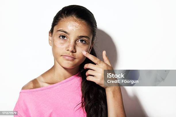 Foto de A Aplicação De Loção Para Pele Queimada De Solsol e mais fotos de stock de Mancha Solar - Mancha Solar, Reflexo de luz - Efeito Fotográfico, Adolescente