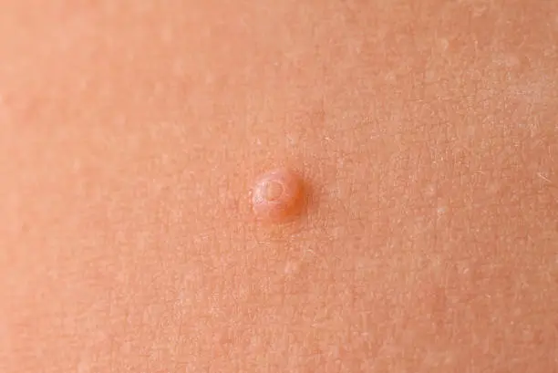 Photo of Detail of a molluscum contagiosum nodule produced by the Molluscipoxvirus virus on the skin of the abdomen of a child.