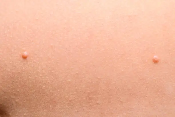 Photo of Detail of a molluscum contagiosum nodule produced by the Molluscipoxvirus virus on the skin of the abdomen of a child.