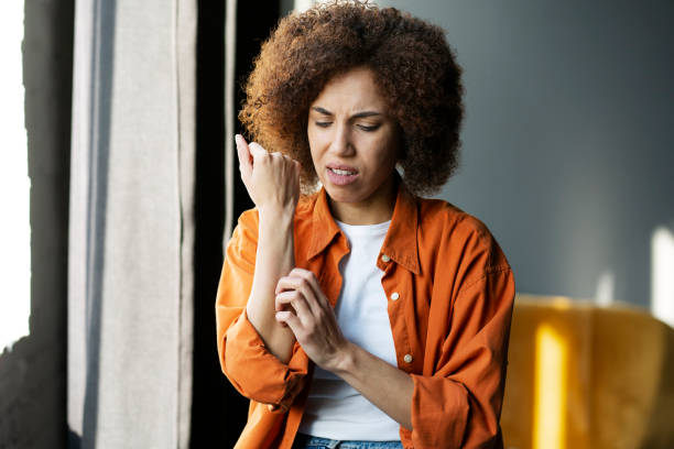 la mujer se rasca la mano enrojecida debido a la picazón. síntomas de alergia. concepto de atención médica - itchy skin fotografías e imágenes de stock