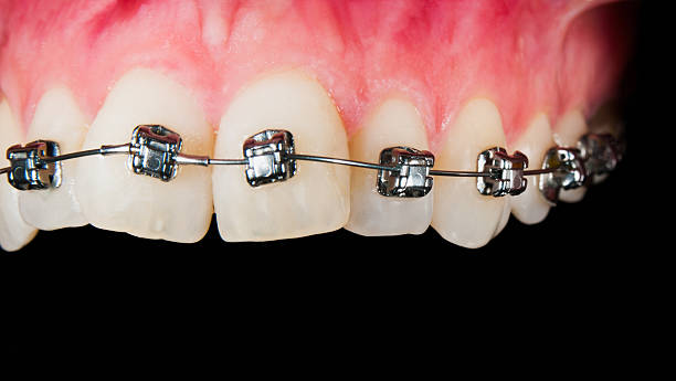 Orthodontic Treatment With Gingival Recesion stock photo