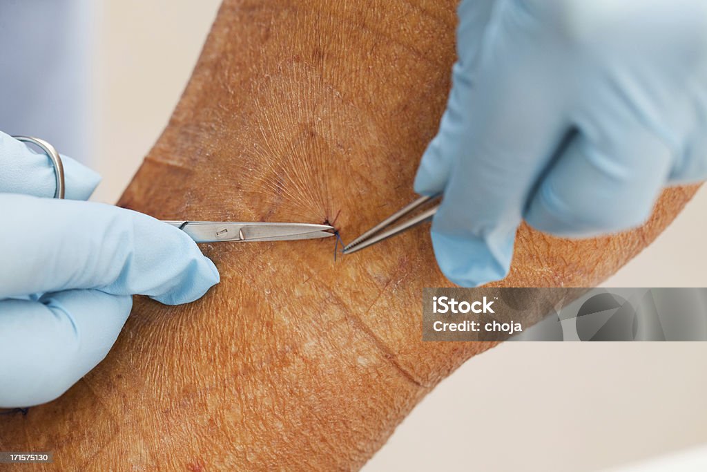 Nurse is taking care of patient after vein stripping Varicose Vein Stock Photo