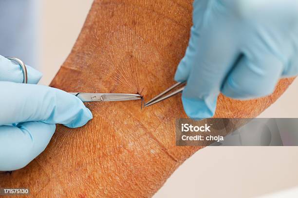 Nurse Is Taking Care Of Patient After Vein Stripping Stock Photo - Download Image Now