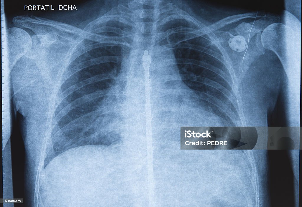 Escoliosis - Foto de stock de Escoliosis libre de derechos