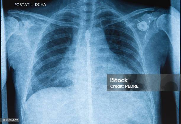 Escoliosis Foto de stock y más banco de imágenes de Escoliosis - Escoliosis, Columna - Parte del cuerpo, Marcapasos