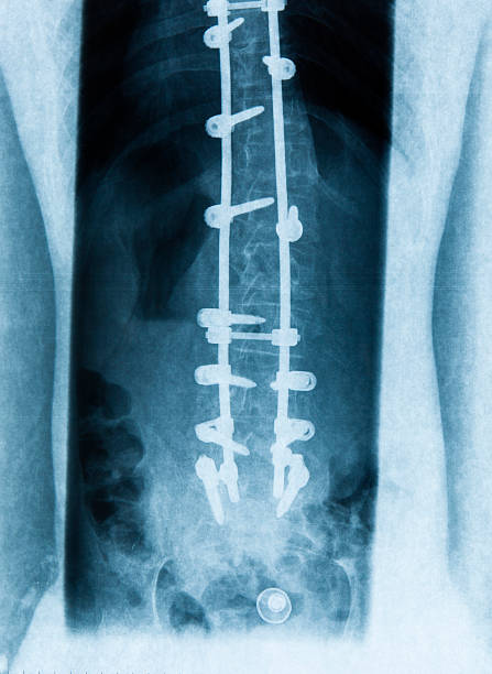 spondylolisthesis - orthopedic equipment osteoporosis x ray human spine 뉴스 사진 이미지