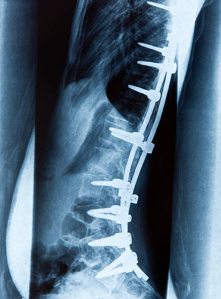 spondylolisthesis - orthopedic equipment osteoporosis x ray human spine 뉴스 사진 이미지