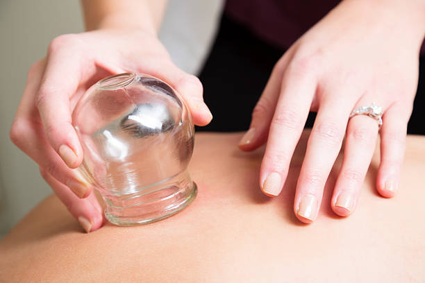 Aupuncturist performs massage cupping therapy An acupuncturist uses the ancient technique of vacuum cupping on a patient's back. You might also be interested in these: cupping therapy stock pictures, royalty-free photos & images