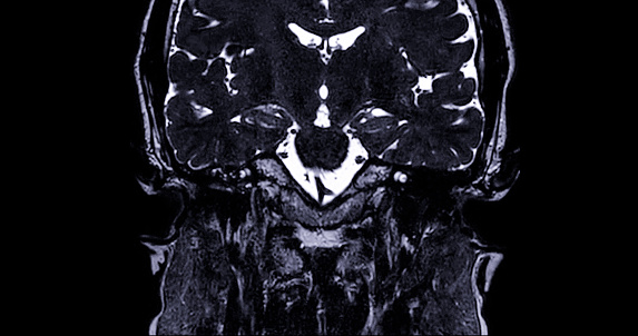 MRI  scan  of  the internal auditory canal (IAC) .