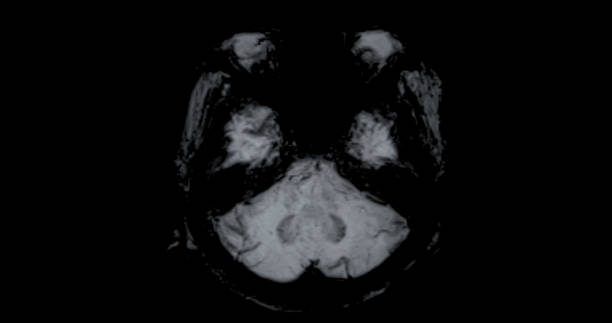 resonancia magnética del cerebro para detectar enfermedades cerebrales sush como enfermedad de accidente cerebrovascular, tumores cerebrales e infecciones. - mri scan brain alzheimers disease medical scan fotografías e imágenes de stock