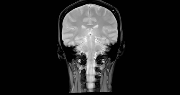 resonancia magnética del cerebro para detectar enfermedades cerebrales sush como enfermedad de accidente cerebrovascular, tumores cerebrales e infecciones. - mri scan brain alzheimers disease medical scan fotografías e imágenes de stock