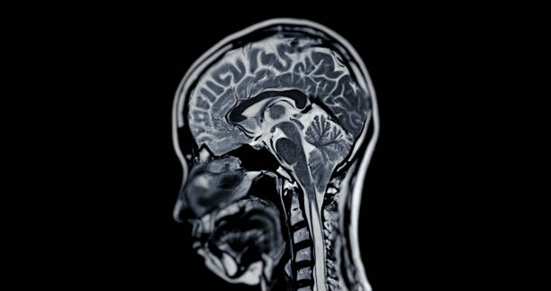 resonancia magnética del cerebro para detectar enfermedades cerebrales sush como enfermedad de accidente cerebrovascular, tumores cerebrales e infecciones. - mri scan brain alzheimers disease medical scan fotografías e imágenes de stock