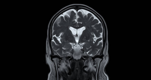 resonancia magnética del cerebro para detectar enfermedades cerebrales sush como enfermedad de accidente cerebrovascular, tumores cerebrales e infecciones. - mri scan brain alzheimers disease medical scan fotografías e imágenes de stock