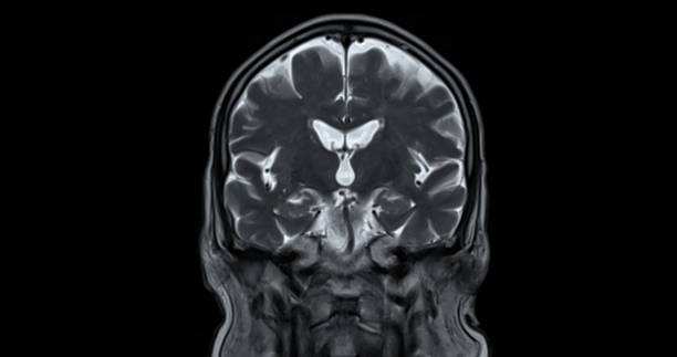 resonancia magnética del cerebro para detectar enfermedades cerebrales sush como enfermedad de accidente cerebrovascular, tumores cerebrales e infecciones. - mri scan brain alzheimers disease medical scan fotografías e imágenes de stock