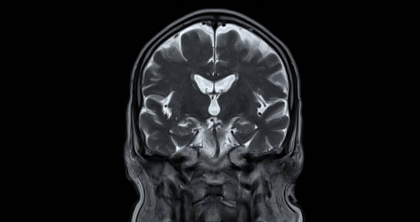мрт головного мозга для выявления заболеваний головного мозга, таких как инсульт, опухоли головного мозга и инфекции. - brain mri scan alzheimers disease medical scan стоковые фото и изображения