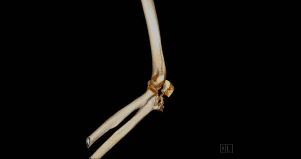 istock CT scan of elbow joint 3d rendering . 1716117352