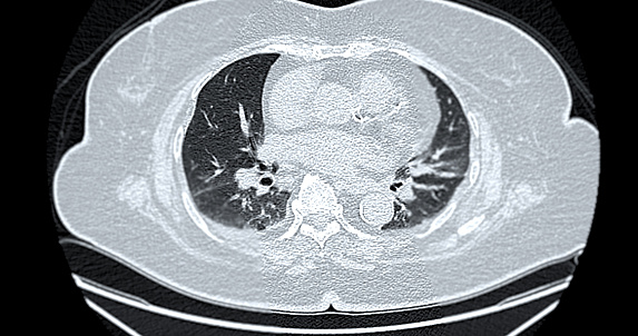 CT scan of Chest axial view for diagnostic Pulmonary embolism (PE) , lung cancer and covid-19.