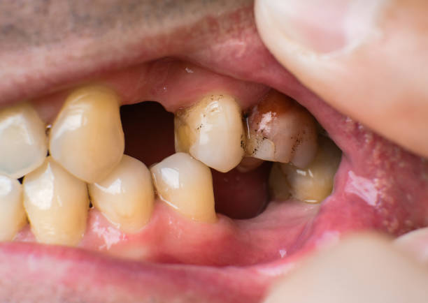 istock Missing teeth and dental problems in a caucasian man close-up 1716532754