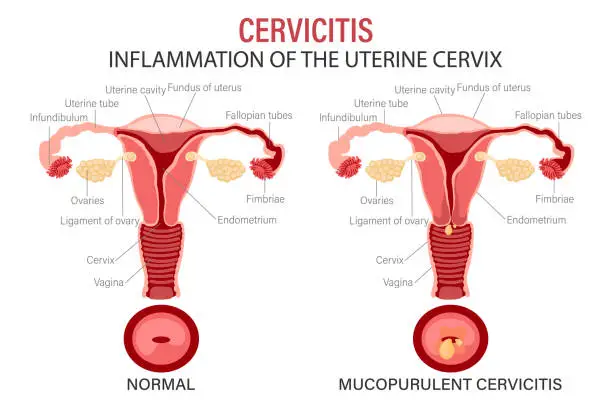 Vector illustration of Cervicitis, diseases of the female reproductive system. Schematic representation of the uterus and cervix. Medical infographic banner.