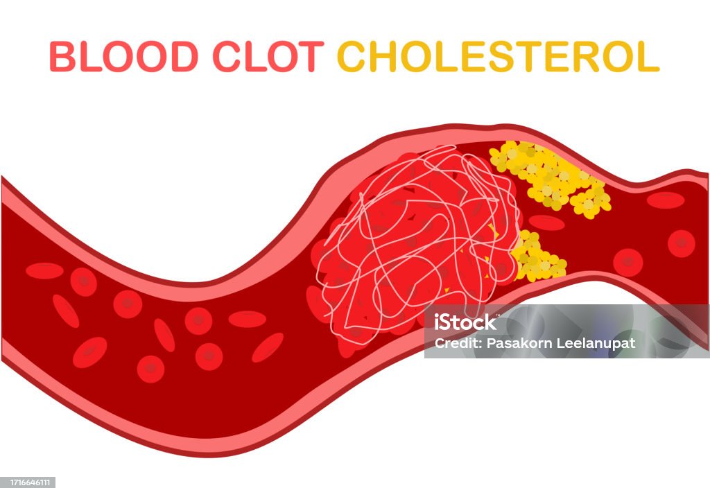Ilustración de El Colesterol En La Sangre El Colesterol Y Otras
