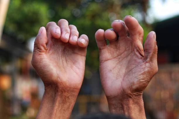 istock hand is injured by exposure to hot water 1716916895