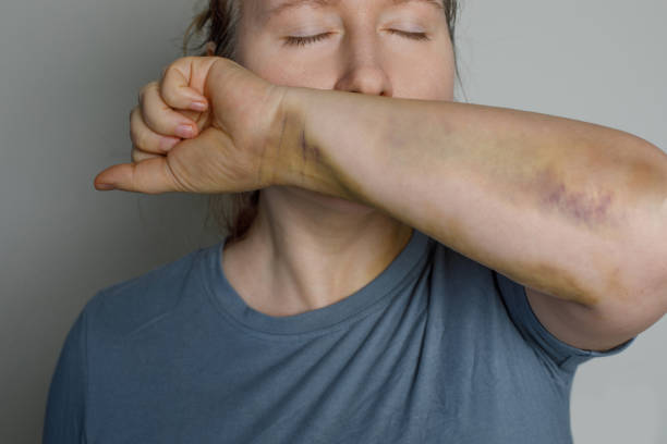 attractive young woman with injury bruise on her hand, closeup portrait. - auto accidents ambulance car physical injury imagens e fotografias de stock