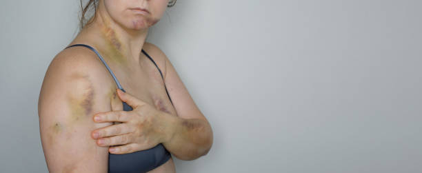 life hurts. woman with bruise injury. stop violence and car accident scar concept - auto accidents ambulance car physical injury imagens e fotografias de stock