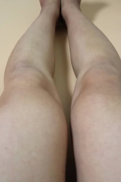 istock Legs after removing unwanted hair 1718814481