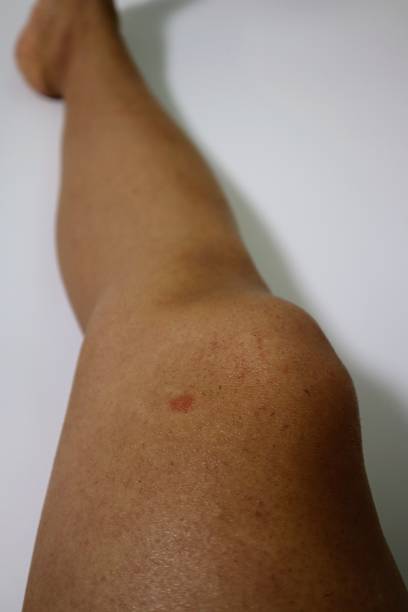 istock Legs after removing unwanted hair 1718821743