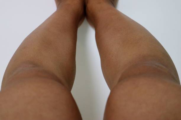 istock Legs after removing unwanted hair 1718823427