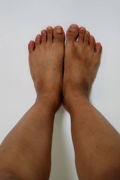 istock Legs after removing unwanted hair 1718824045