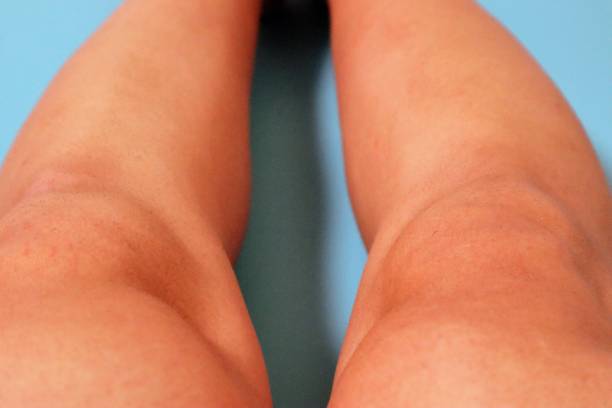 istock Legs after removing unwanted hair 1718826269
