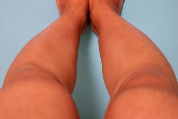 istock Legs after removing unwanted hair 1718828521