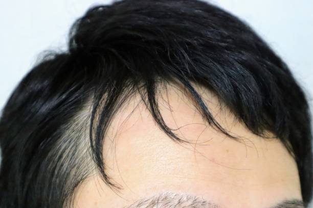 istock Japanese man with thin hair 1718856167