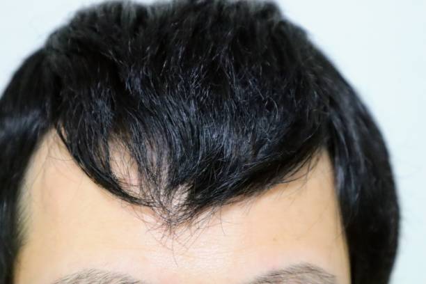istock Japanese man with thin hair 1718859448