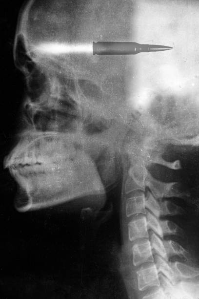 머리에 총알이 박힌 여성 두개골의 엑스레이, 머리에 총을 맞은 총, 총 - x ray x ray image bullet shooting 뉴스 사진 이미지