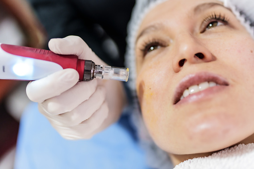 Beautician applying dermapen treatment with hyaluronic acid to an adult woman
