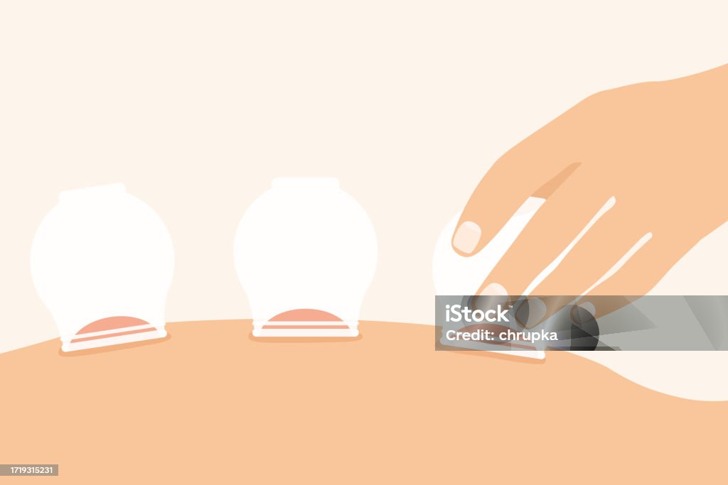 뒤쪽에 의료 부항 요법 부항기에 대한 스톡 벡터 아트 및 기타 이미지 - 부항기, 침술, 중국 - iStock