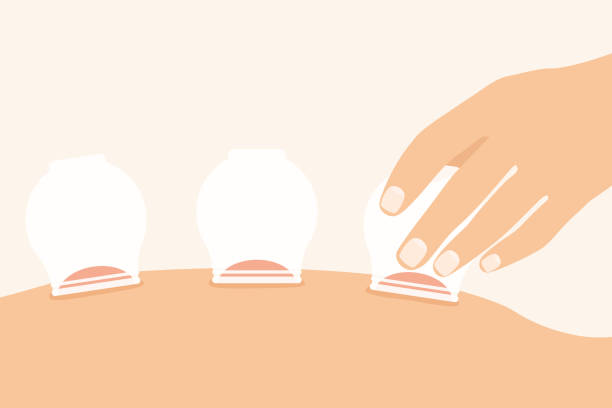medical cupping therapy on the back medical cupping therapy on the back- vector illustration cupping therapy stock illustrations
