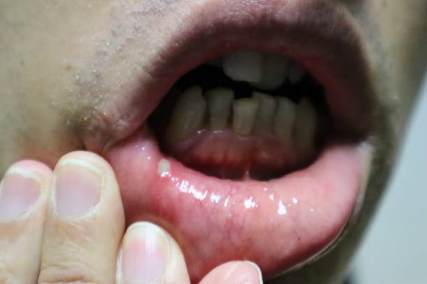 istock A person suffering from canker sores 1719790160