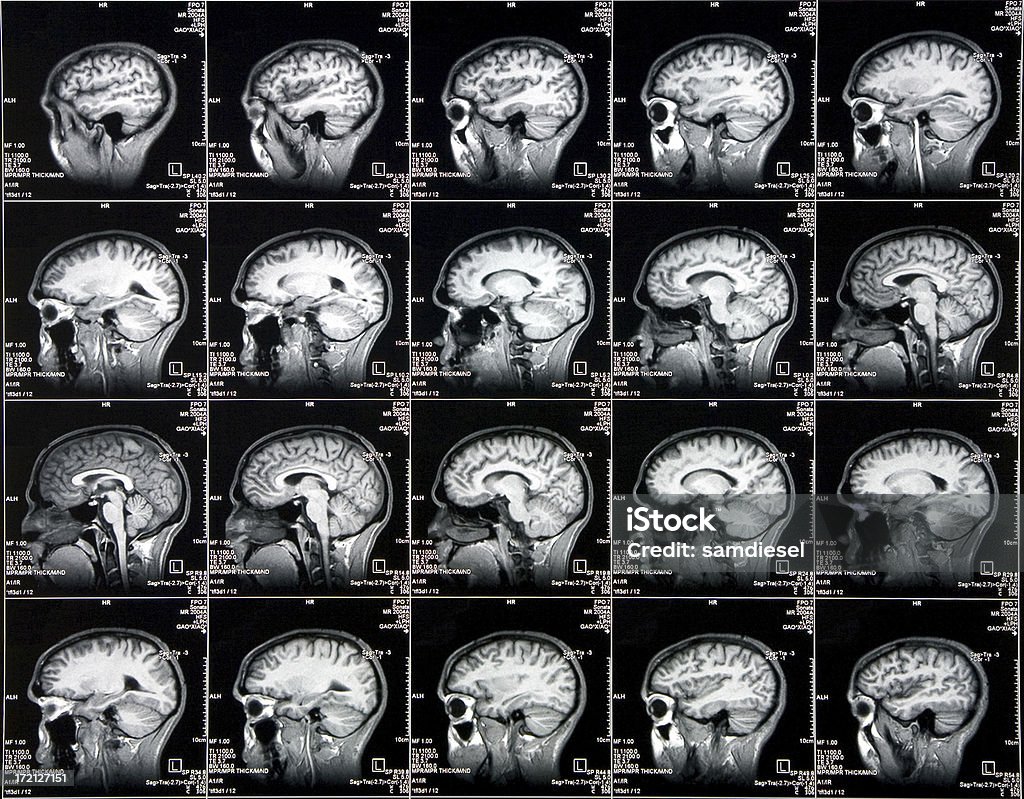 Vue latérale de cerveau Tomographie axiale informatisée - Photo de Cerveau libre de droits