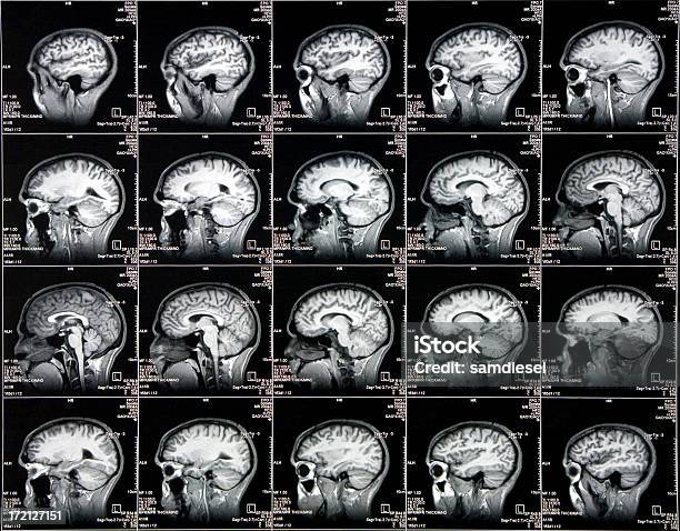 뇌 Cat 스캔 측면 보기 뇌에 대한 스톡 사진 및 기타 이미지 - 뇌, 의료용 스캔, CAT 스캔