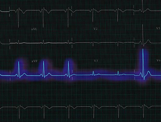 QRS (ECG) waveform stock photo